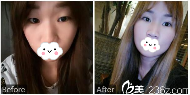 深圳美莱徐占锋医生做的双眼皮案例 深圳美莱徐占锋医生做的双眼皮案例