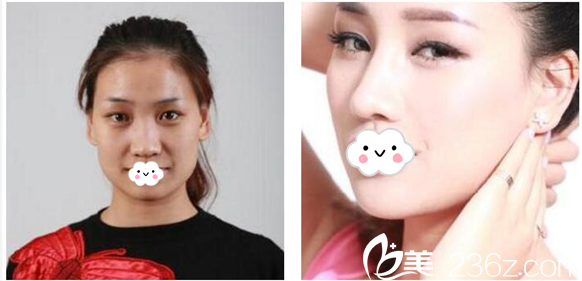 深圳美莱徐占锋医生隆鼻案例前后对比图 深圳美莱徐占锋医生隆鼻案例前后对比图