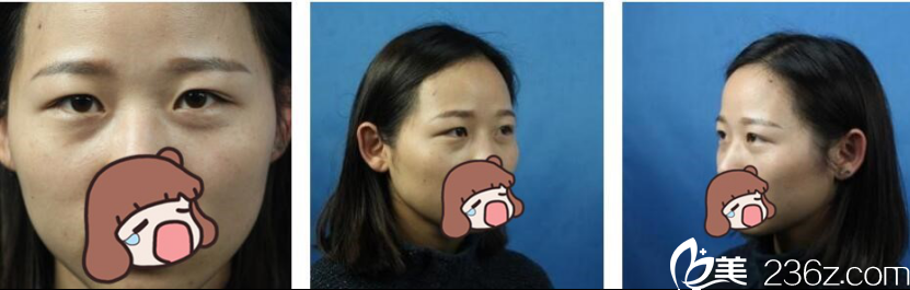 长沙美莱 双眼皮开眼角案例 长沙美莱 双眼皮开眼角案例