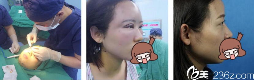 长沙美莱潘卫峰自体脂肪面部填充案例 长沙美莱潘卫峰自体脂肪面部填充案例