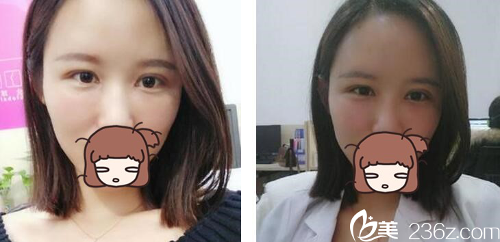 自体脂肪丰额头+双眼皮真人案例 自体脂肪丰额头+双眼皮真人案例