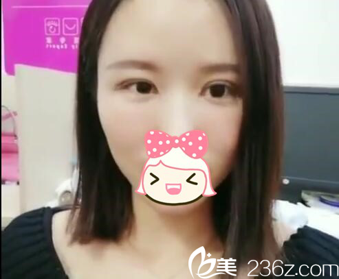 术后第28天 术后第28天