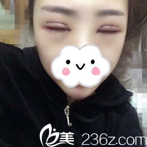 术后第三天 术后第三天