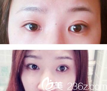 兰州明伦双眼皮失败修复效果案例 兰州明伦双眼皮失败修复效果案例