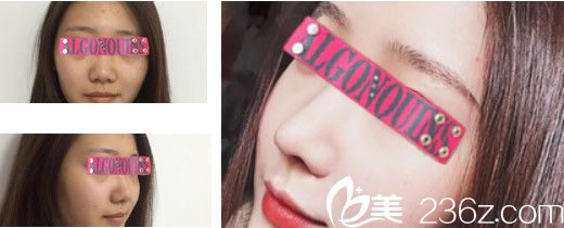 兰州明伦隆鼻案例 兰州明伦隆鼻案例