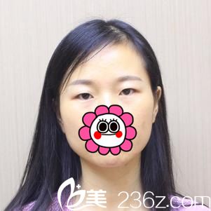 术前单眼皮 术前单眼皮