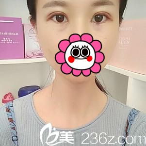 术后四天效果 术后四天效果