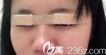兰州明伦双眼皮整形天 兰州明伦双眼皮整形天