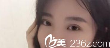 兰州明伦整形冯建业医生给我做的切开法双眼皮好不好 大家帮我鉴定一下