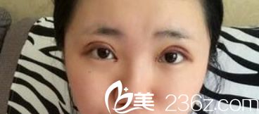 兰州明伦双眼皮整形天 明伦割双眼皮第三天 兰州明伦双眼皮整形天 明伦割双眼皮第三天