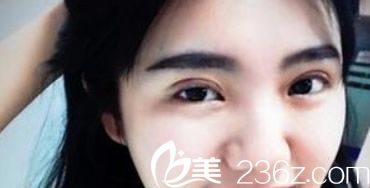 兰州明伦双眼皮第十天效果 兰州明伦双眼皮第十天效果
