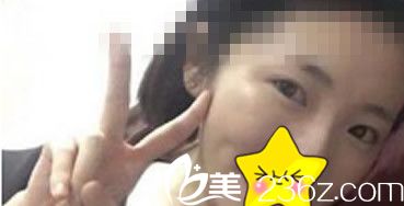 兰州明伦冯建业切开法双眼皮前 兰州明伦冯建业切开法双眼皮前