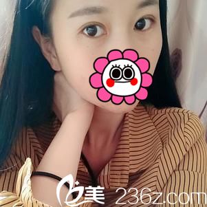 宜昌前卫李传荣院长切开双眼皮+开内眼角1个月恢复详情报告