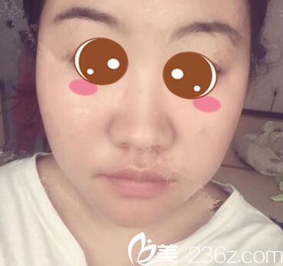 在郑州梨花雨做隆鼻术前