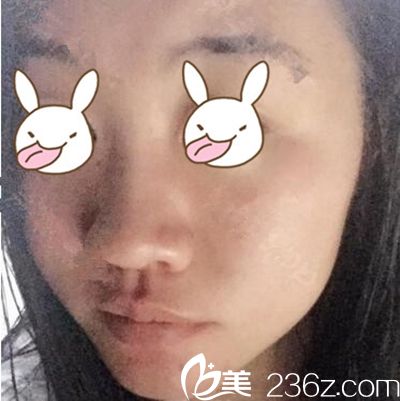 郑州梨花雨隆鼻术前