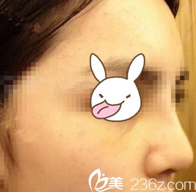 美鼻代言：商丘姑娘在郑州梨花雨隆鼻变美记 