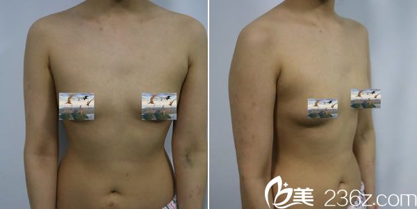 在金华亚美做自体脂肪隆胸前的平胸照片 在金华亚美做自体脂肪隆胸前的平胸照片