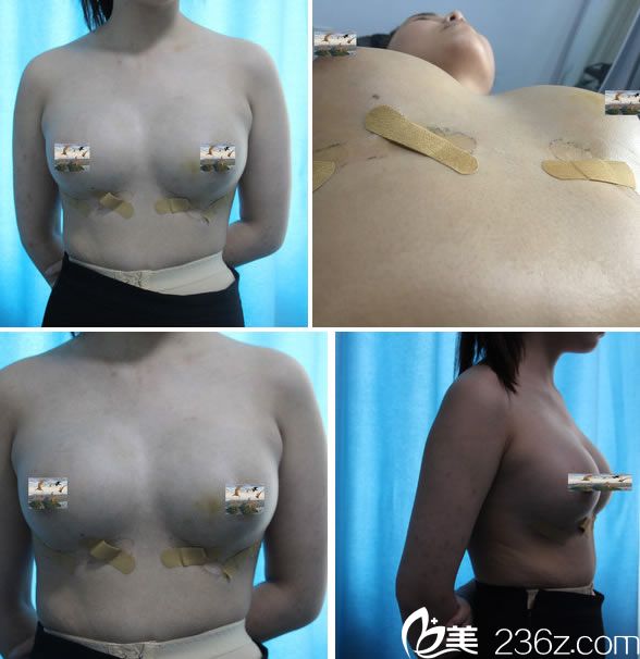 自体脂肪隆胸手术7天恢复照 自体脂肪隆胸手术7天恢复照