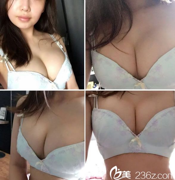 隆胸手术16天的恢复<span style= 隆胸手术16天的恢复<span style=