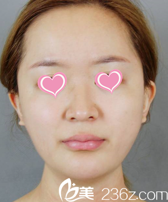 我去遵义利美康整形医院面诊前 我去遵义利美康整形医院面诊前