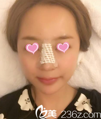 术后第二天 术后第二天