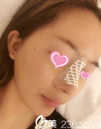 术后3天 术后3天