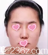 北京美莱注射瘦脸案例术前照片 北京美莱注射瘦脸案例术前照片