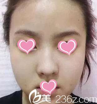 注射瘦脸后第四天 注射瘦脸后第四天