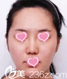 注射瘦脸后第二十三天 注射瘦脸后第二十三天