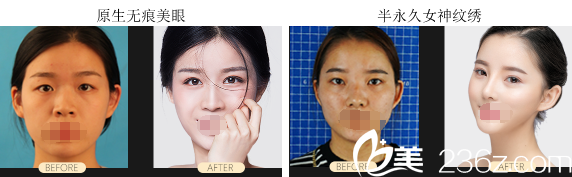 成都艺星双眼皮+纹眉案例对比 成都艺星双眼皮+纹眉案例对比
