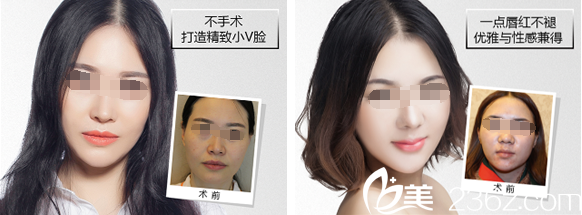 成都艺星瘦脸+半水晶唇案例 成都艺星瘦脸+半水晶唇案例