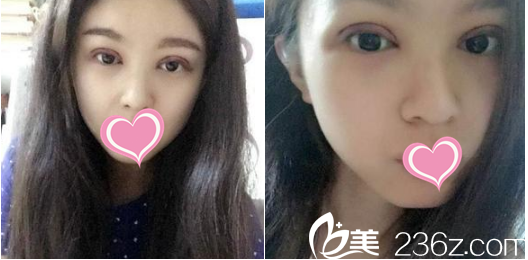 双眼皮好肿哦