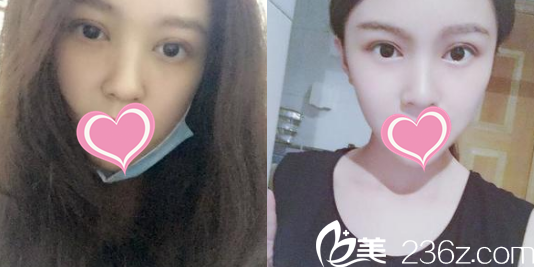 宋方医生给我做的双眼皮样子