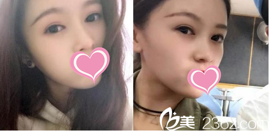 菏泽华美做双眼皮手术比较厉害，并且收费价格也能接受