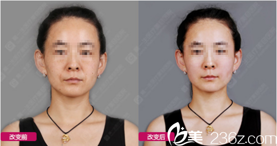 金磊医生玻尿酸丰苹果肌<span style=