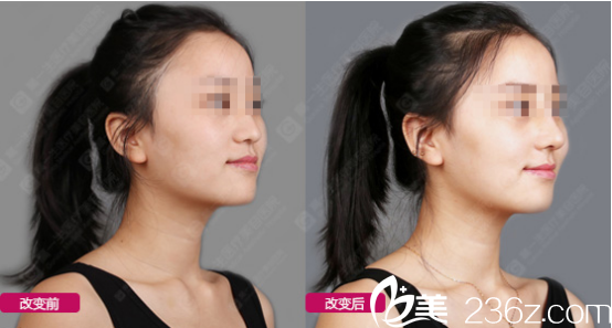 西安高一生玻尿酸丰苹果肌<span style=