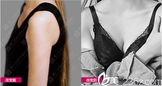 西安高一生假体隆胸<span style=