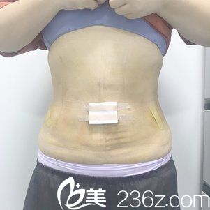腰腹部吸脂7天恢复情况 腰腹部吸脂7天恢复情况