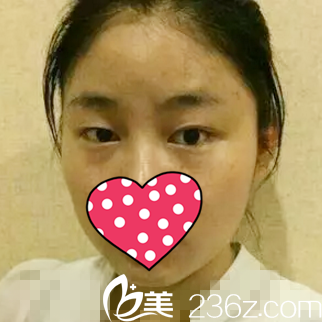 做双眼皮手术前 做双眼皮手术前