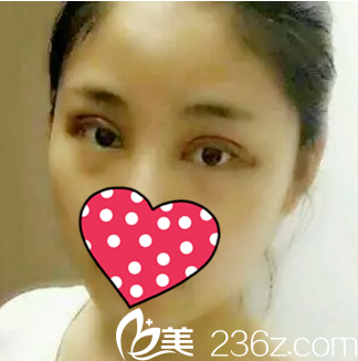 割双眼皮术后第二天 割双眼皮术后第二天