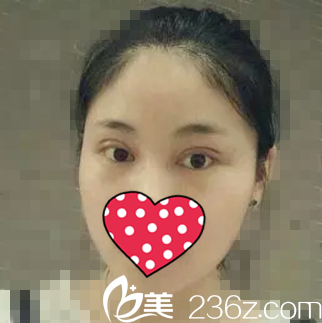 做双眼皮术后一周 做双眼皮术后一周