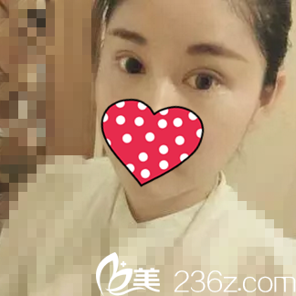 双眼皮手术术后20天效果 双眼皮手术术后20天效果