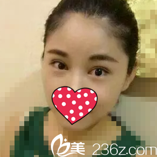 术后一个月恢复情况 术后一个月恢复情况