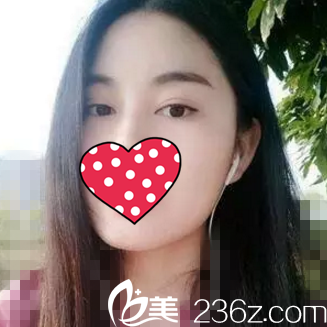 闺蜜看到我找米兰辰杉王志军做的双眼皮恢复后效果，说她也要去