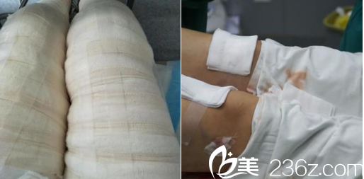 <!--<i data=20240703-sp></i>-->医生给我做了吸脂手术就这样子了