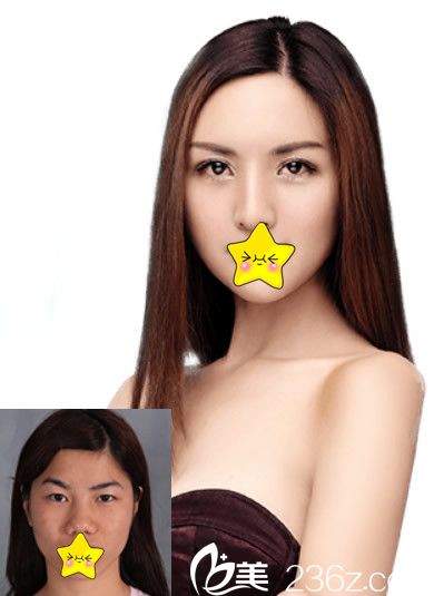 兰州崔大夫徐生眼鼻整形效果案例