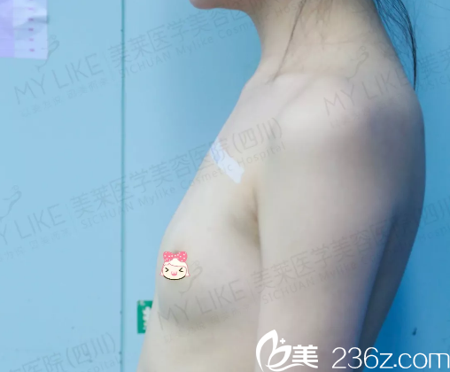 丰胸术前“一马平川”的我 丰胸术前“一马平川”的我