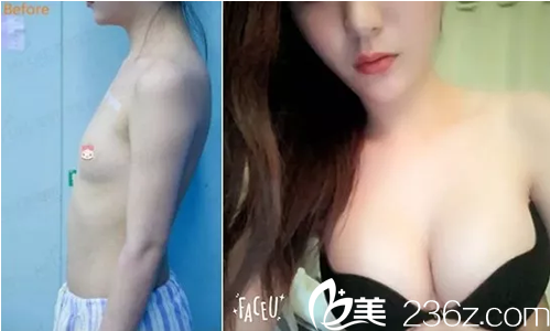 四川美莱吴江山自体脂肪丰胸前后对比 四川美莱吴江山自体脂肪丰胸前后对比