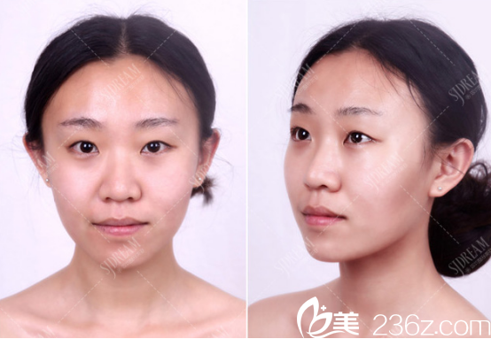 达州双均医院双眼皮案例术前照片