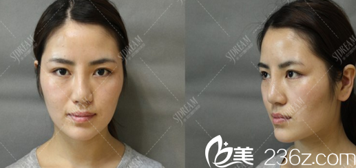 达州双均医院面部轮廓整形术前照片